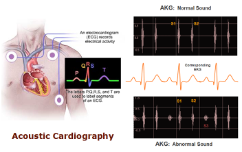 Acoustic Cardiography — AKG Normal and Abnormal Sound Analysis